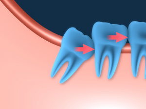 'impacted wisdom tooth'